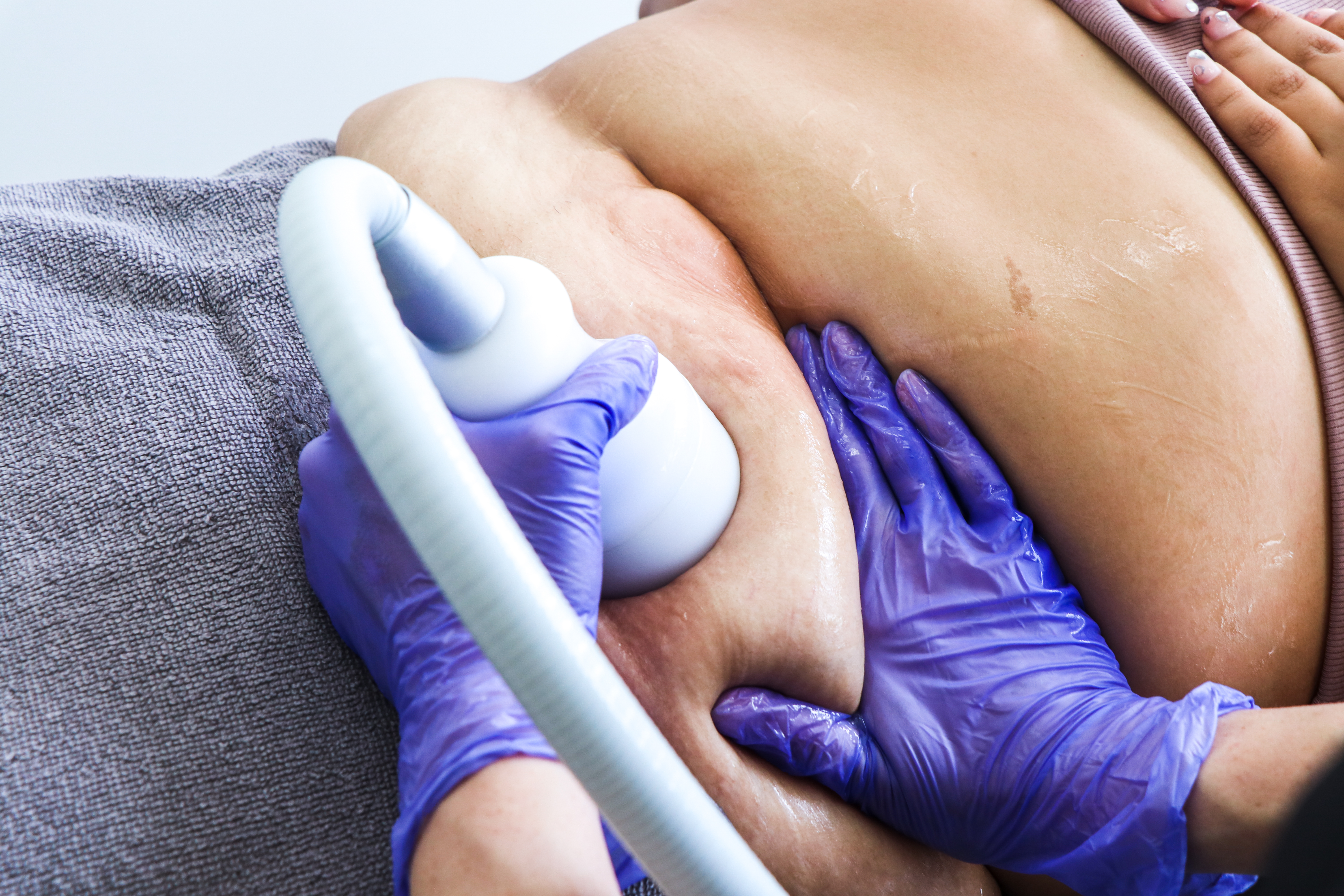 Neveskin slimming on the body